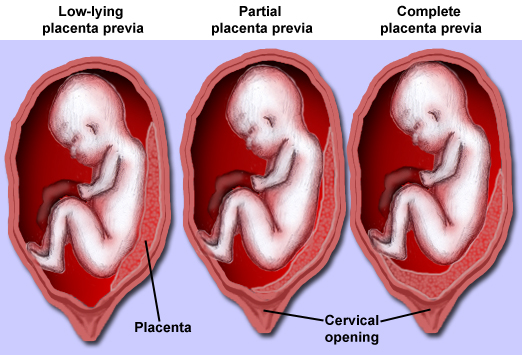 Placenta Previa | BabyMed.com