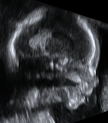 18 weeks fetus ultrasound profile