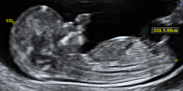 9 week fetus ultrasound