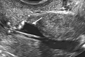  Cesarean Scar Defect Ultrasound Sonogram