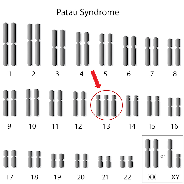 Patau syndrome chromosome 13 trisomy 