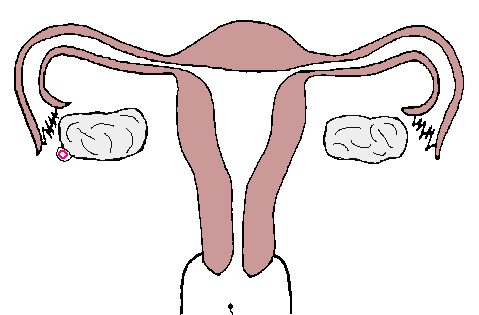 Ruptured-ectopic-pregnancy