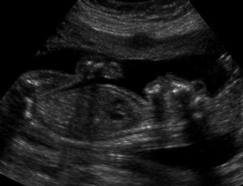 Anencephalus Pregnancy Ultrasound
