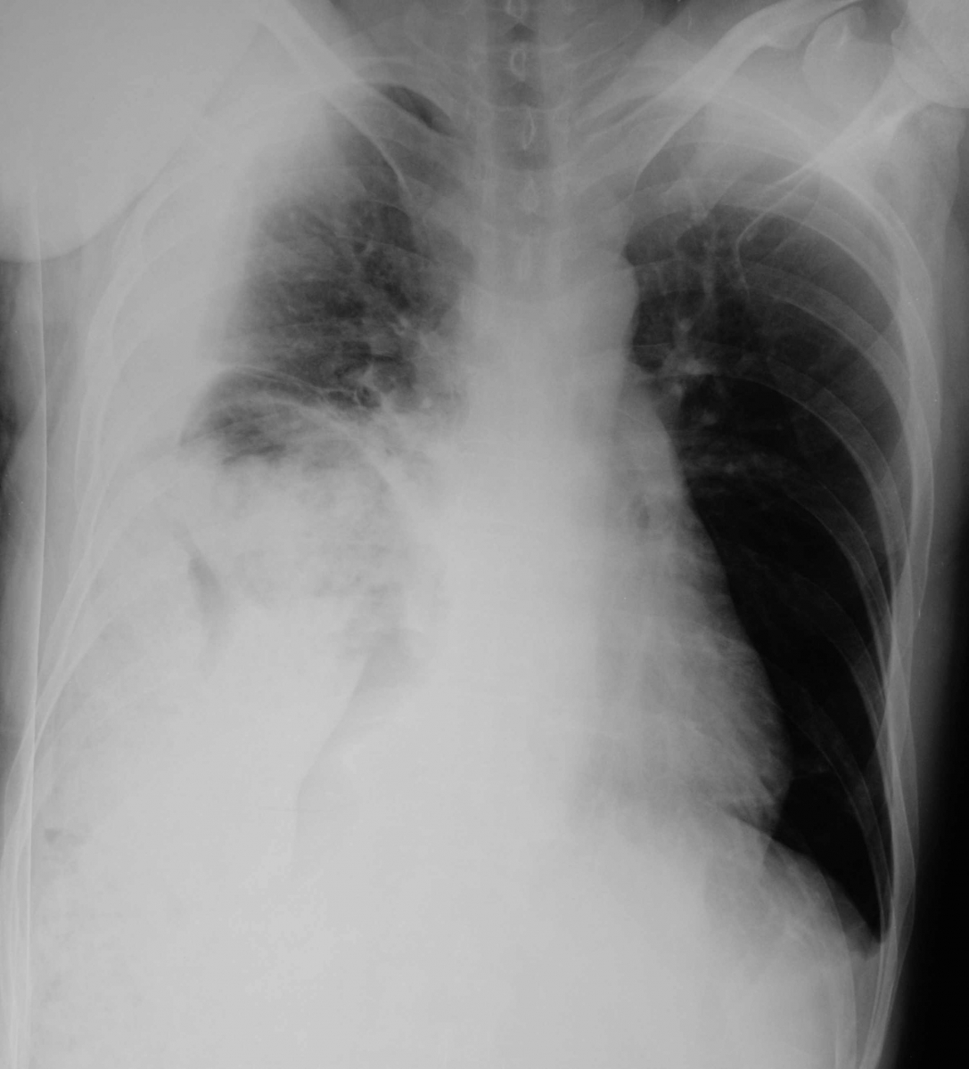 X Ray Diaphragmatic Hernia