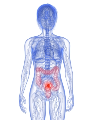 colon-cancer-symptoms.jpg
