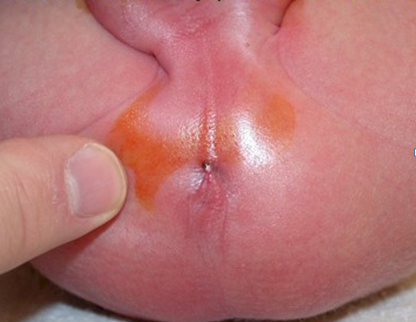 Imperforate anus newborn