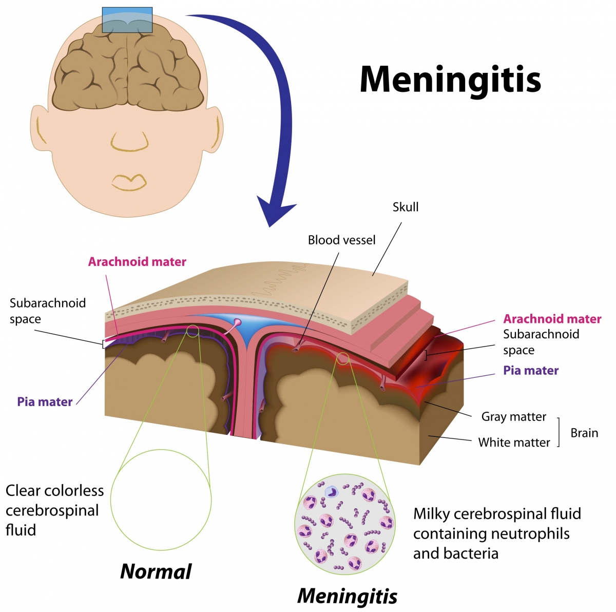 Meningitis During Pregnancy