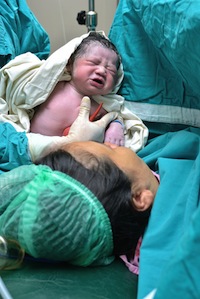 Newborn cesarean gallery