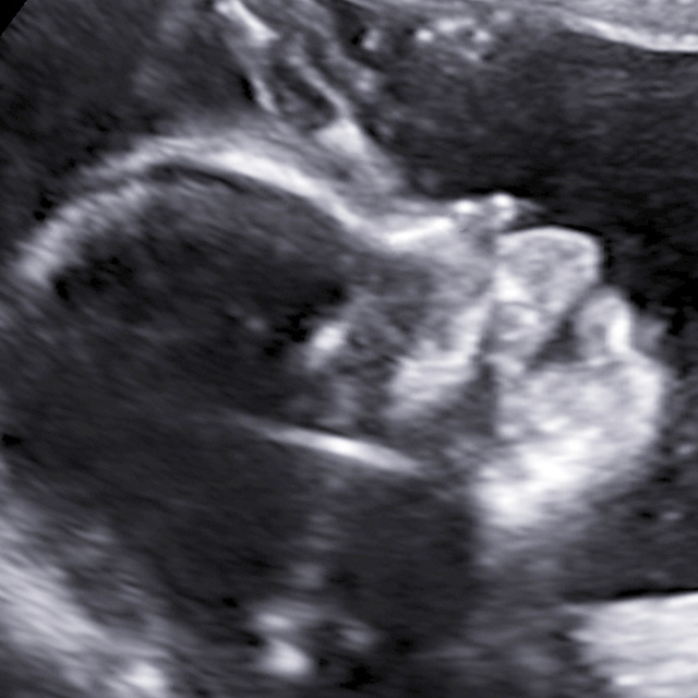 pregnancy fetus week 20