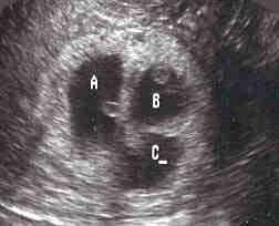 Pregnancy Ultrasound Triplets  Gestational Sacs