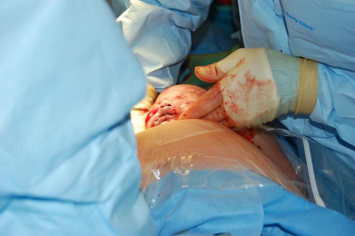Vaginal Birth After Cesarean Section
