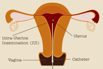 IUI-intrauterine-insemination