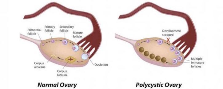 Polycystic Ovarian Syndrome Ovary 