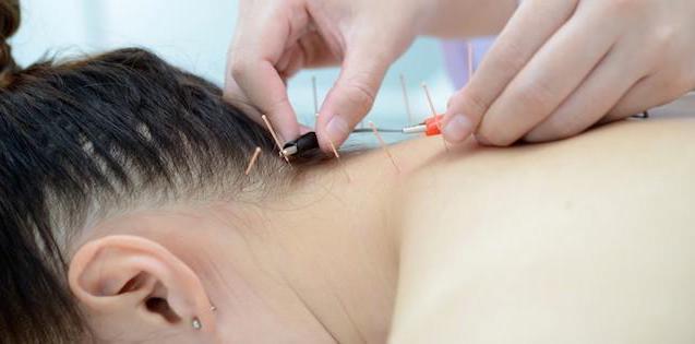 acupuncture-and-fertility