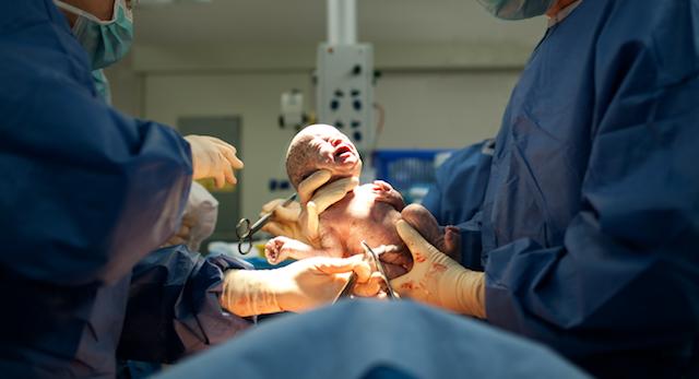 cesarean section with baby