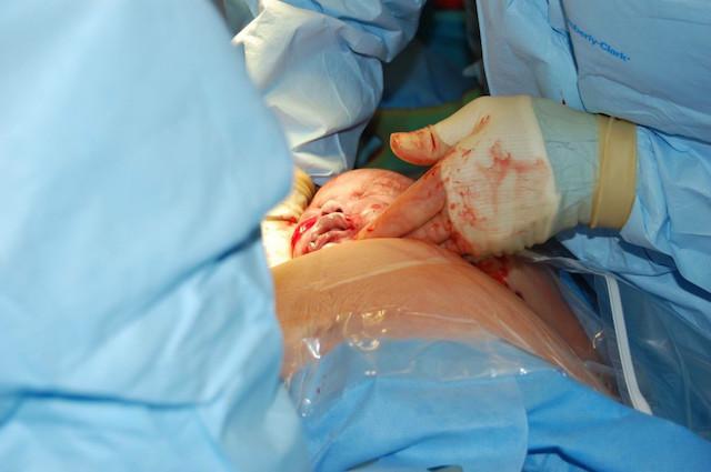 Cesarean Section Scarring Future Implantation