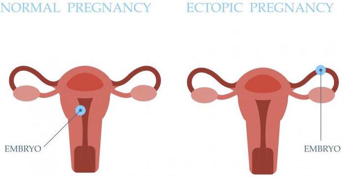 Ectopic Pregnancy: Symptoms, Risks, Causes