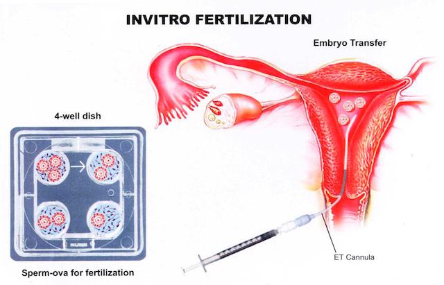 embryo-transfer-et-ivf