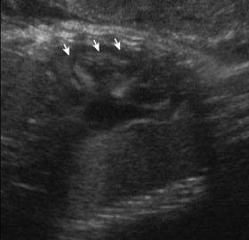 ultrasound, fetus, Down syndrome (Trisomy 21), sonogram, heart
