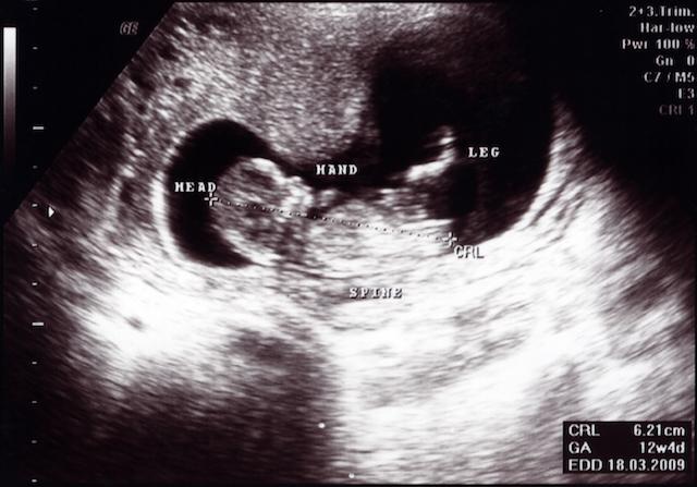 Embryo Size Chart Mm