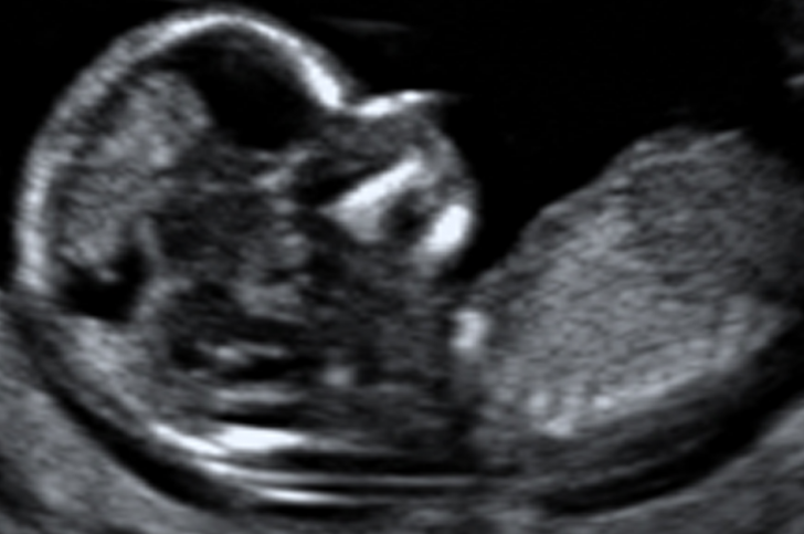 first-trimester-nuchal-screen-fetus