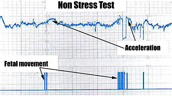non stress test