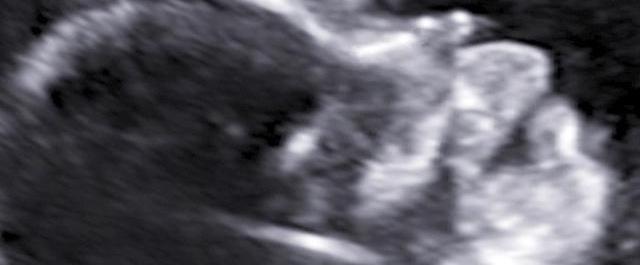 pregnancy fetus week 20 ultrasound