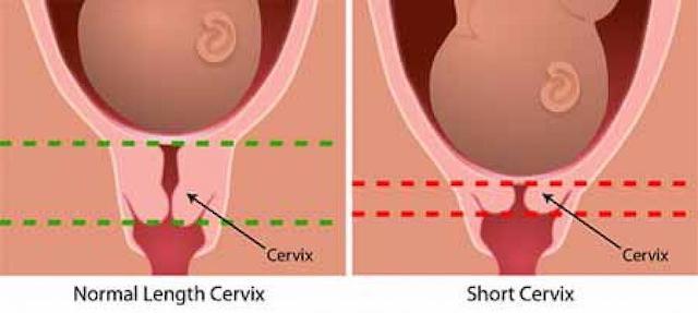 Short Cervix In Pregnancy and Risk of Premature Delivery