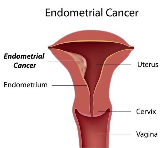 Introduction to Endometrial Cancer: Causes and Risk Factors