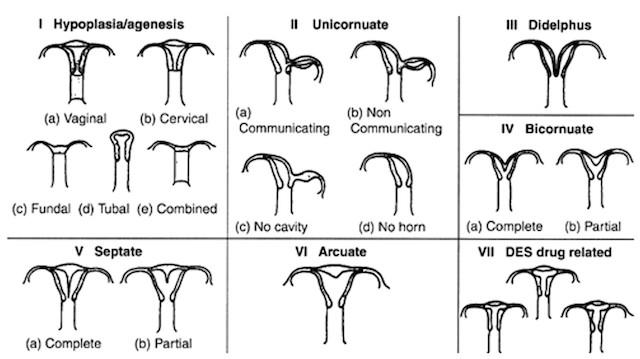 uterus anomalies bicornuate uterus