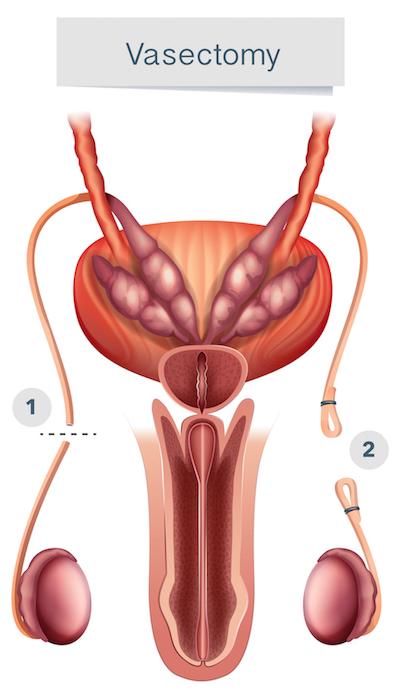 vasectomy-male-contraception