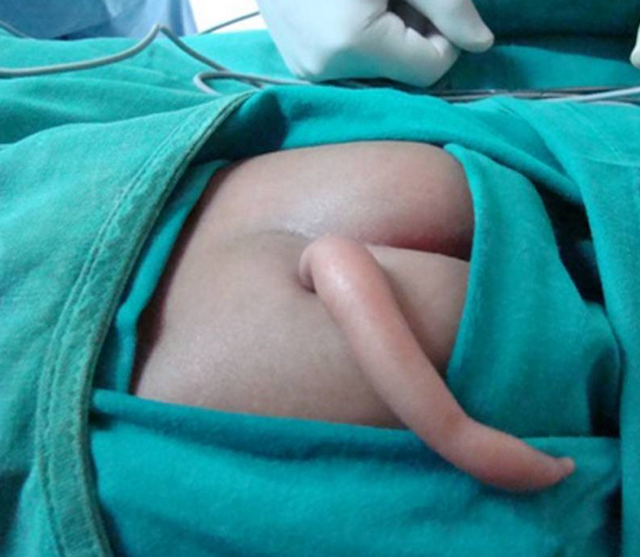 vestigial tail caudal appendage newborn child.png
