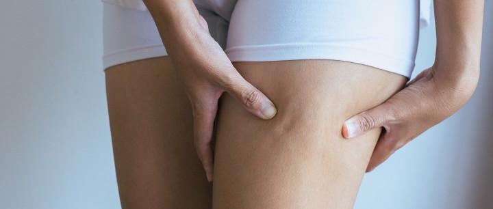 Cellulite Treatments During Pregnancy
