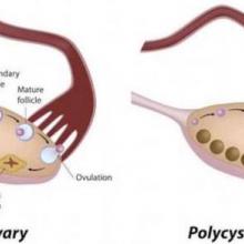 Polycystic Ovarian Syndrome Ovary 