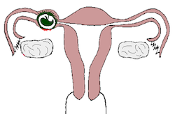 Ectopic Pregnancy and Fertility