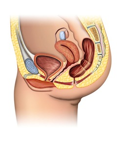 urinary incontinence 