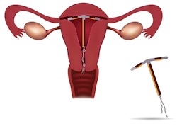 intrauterine device (IUD)