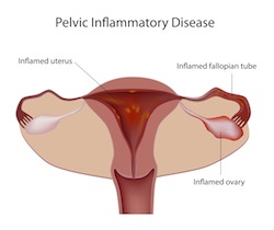 pelvic inflammatory disease (PID)